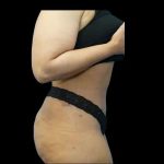 Tummy Tuck Before & After Patient #422
