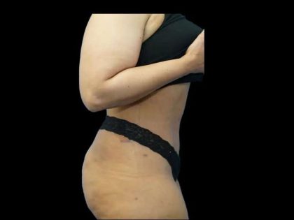 Tummy Tuck Before & After Patient #422