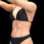 Liposuction Before & After Patient #429