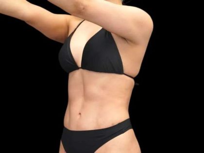 Liposuction Before & After Patient #429