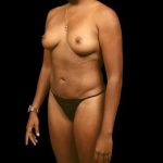 Liposuction Before & After Patient #434