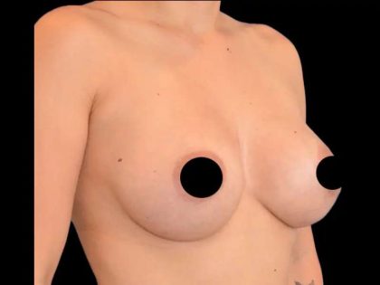 Breast Augmentation Before & After Patient #499