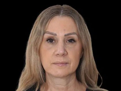 Rhinoplasty Before & After Patient #291