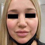 Rhinoplasty Before & After Patient #296