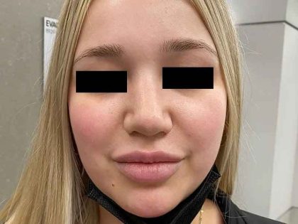 Rhinoplasty Before & After Patient #296