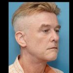 Necklift Before & After Patient #304