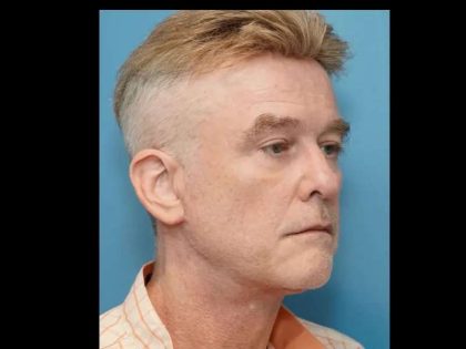 Necklift Before & After Patient #304