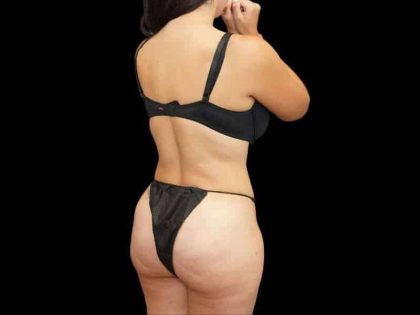 Brazilian Butt Lift Before & After Patient #311