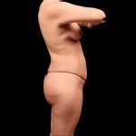 Brazilian Butt Lift Before & After Patient #362