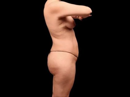 Brazilian Butt Lift Before & After Patient #362