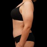 Tummy Tuck Before & After Patient #379