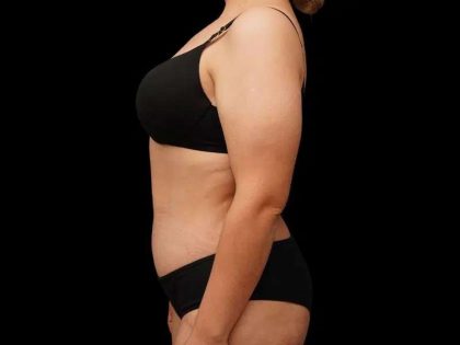 Tummy Tuck Before & After Patient #379