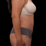 Tummy Tuck Before & After Patient #386