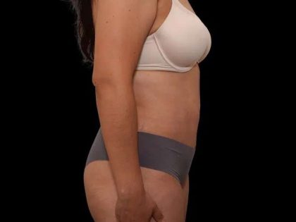 Tummy Tuck Before & After Patient #386