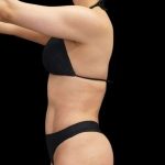 Liposuction Before & After Patient #429