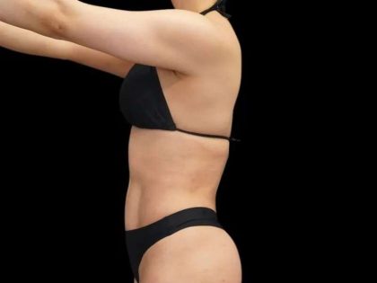 Liposuction Before & After Patient #429