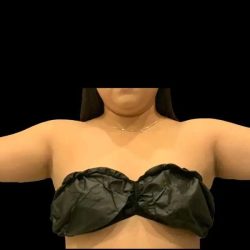 Liposuction Before & After Patient #611