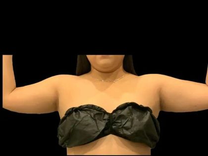 Liposuction Before & After Patient #611