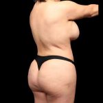 Mommy Makeover Before & After Patient #478
