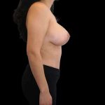 Mommy Makeover Before & After Patient #485