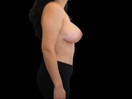 Mommy Makeover Before & After Patient #485