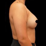 Breast Augmentation Before & After Patient #506
