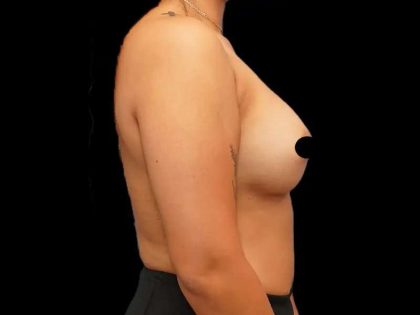 Breast Augmentation Before & After Patient #506