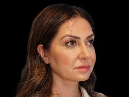 Rhinoplasty Before & After Patient #274