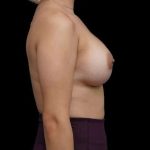 Breast Augmentation Before & After Patient #553
