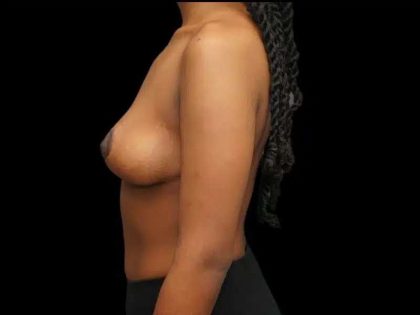 Breast Lift Before & After Patient #601