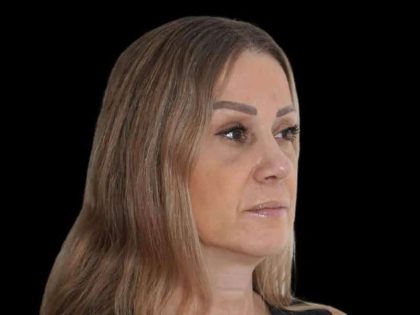 Rhinoplasty Before & After Patient #291