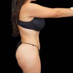 Brazilian Butt Lift Before & After Patient #311