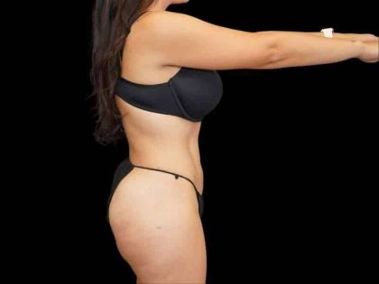 Brazilian Butt Lift Before & After Patient #311