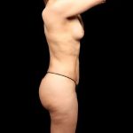 Brazilian Butt Lift Before & After Patient #318