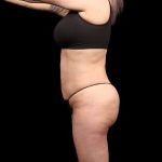 Brazilian Butt Lift Before & After Patient #350