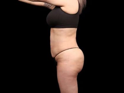 Brazilian Butt Lift Before & After Patient #350