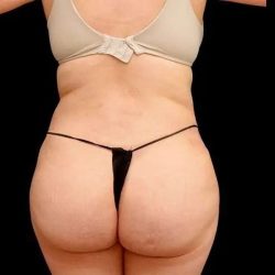 Liposuction Before & After Patient #464