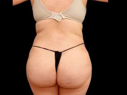 Liposuction Before & After Patient #464