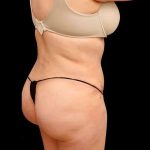 Liposuction Before & After Patient #464