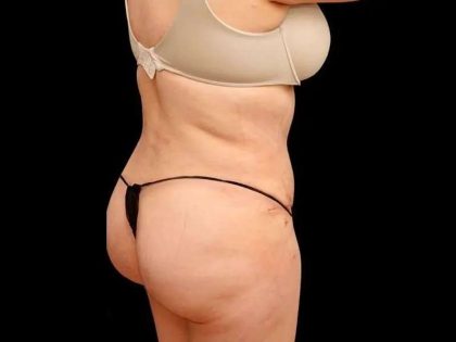 Liposuction Before & After Patient #464
