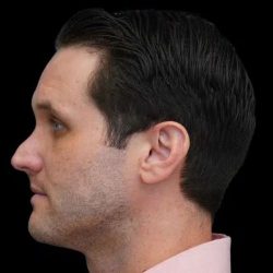 Rhinoplasty Before & After Patient #260