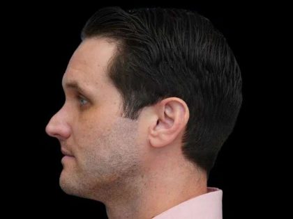 Rhinoplasty Before & After Patient #260