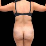 Brazilian Butt Lift Before & After Patient #311
