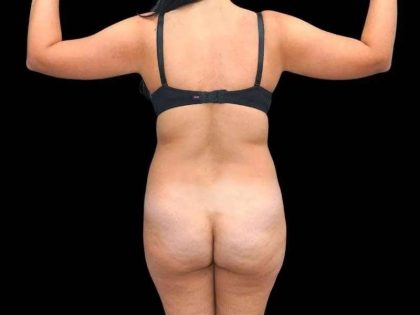 Brazilian Butt Lift Before & After Patient #311