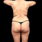 Brazilian Butt Lift Before & After Patient #318