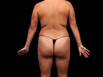 Brazilian Butt Lift Before & After Patient #325