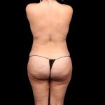 Brazilian Butt Lift Before & After Patient #330