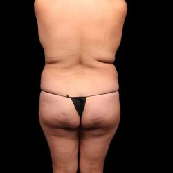 Brazilian Butt Lift Before & After Patient #338