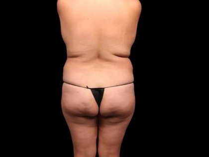 Brazilian Butt Lift Before & After Patient #338