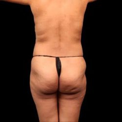 Brazilian Butt Lift Before & After Patient #355
